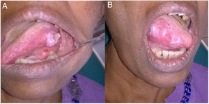 (A) Ulcerative lesions on lateral border of the tongue. (B) Multiple lesions on the other side of the tongue.