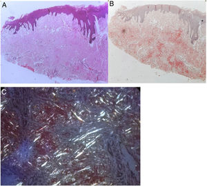 (A) Homogenous eosinophilic material in the corium (H&E, ×40). (B) Congo red stain with salmon pink positivity. (C) Green birefringence under polarized light.