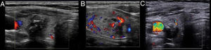 Subjective color Doppler ultrasound diagnosis. A, Avascularity; B, Vascularity ≤ 25% of the nodule circumference; C, Flow pattern is greater than that of the surrounding part.