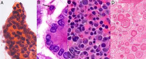 Histopathological features of suspicious malignant nodules. A, True papillae; B, Nuclear pseudo inclusions (black arrow); C, Mild nuclear irregularity (white arrow); and D, Psammoma bodies (black circle) (Hematoxylin & Eosin staining).