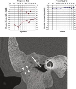 Pure tone audiometry showing severe conductive hearing loss and the presence of Carhart’s notch. Tomography of temporal bones, coronal view, right side. The arrow heads show stenosis of the external auditory meatus and the arrow shows ossicular chain with fixation.