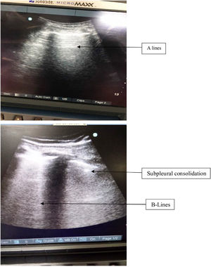 Lung ultrasonography of right upper and lower quadrants. Lower quadrant shows the presence of subpleural consolidation and multiple B lines.