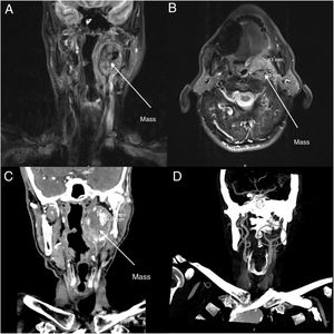 (A and B) MRI images of the patient in axial (A) and coronal (B) plane. (C) CT images of the patient in the coronal plane. (D) Angiography images of the patient in coronal plane.