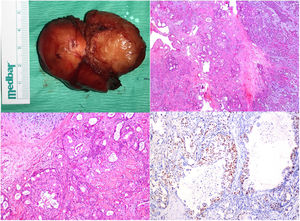 (a) Macroscopic view of the tumor. (b) Tumoral infiltrate progressing in the glandular pattern of the hyalinized stroma, adjacent to the pleomorphic adenoma parenchyma containing the chondromyxoid matrix (H&E, ×10). (c) Cribriform glands containing areas of comedo necrosis in their lumen (H&E, ×10). (d) Nuclear Androgen receptor staining in tumor cells (×20).