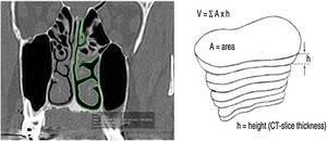 Coronal cut area delimitation and volume reconstruction. (A, CT coronal Cut; B, Reconstruction Technique) (From Rodrigues et al., 2017).5.