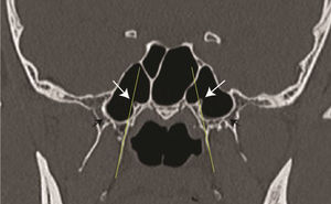 Coronal CT scan showing the position of the vidian canal (white arrow) in the same plane as that of the medial pterygoid plate (thin yellow line) on the left side and medial to this plane on the right side. Black arrows indicated a pneumatised pterygoid plate.