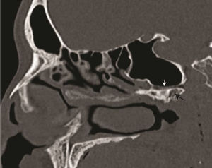Sagittal computed tomography scan slide showing the vidian canal (white arrow) and a pneumatised pterygoid process (black arrow).