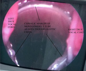 Montgomery T-tube's vertical limb's upper margin as seen through the vocal cords on direct/flexible laryngoscopy.