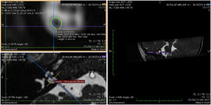 3D Multi-Planar Reformatting mode (3D MPR) in OsiriX site of the calculated diameter of the cochlear nerve.