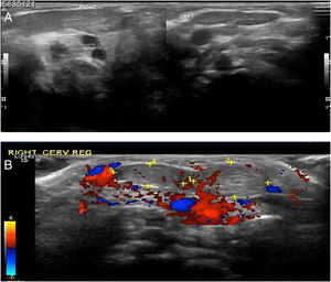 The ultrasound finding on figure A and B demonstrate bulky right sternocleidomastoid muscle as compared to the left side.