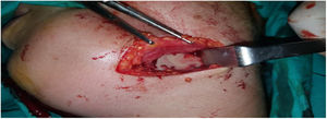 Drainage of left submandibular abscess.