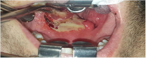 Drainage of the left peritonsillary abscess.