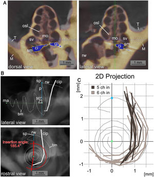 Insertion path reconstruction. A, Dorsal and lateral view of µCT data from an implanted cochlea (yellow, M) to the unimplanted template (grey, T) is depicted. The registration was performed to obtain the most agreement between the bony cochleae. The position of the CI with the µCT blooming artefacts is shown in blue (ci: cochlear implant; mo: modiolus; rw: round window; sm: scala media; sv: scala vestibuli). B, Lateral and rostral view of a digital radiograph view (from µCT data in Amira) of the non-implanted template with the reconstructed basilar membrane position (bm) and a superimposed exemplary cochlea implant position (cip) reconstruction. The images show the mid-modiolar axis (ma), the summit point of the basilar membrane reconstruction (sp) and the perpendicular to the modiolar axis (p). The measurement of the insertion angle (here 185.4°) is exemplified in the rostral view. C, Two dimensional projections in basal to apical direction of 15 cochlear implant positions from µCT data relative to the basilar membrane reconstruction. A pronounced difference in insertion depth between 5 contact (5Ch in, dark grey) and 6 contact (6Ch in, light grey) insertions is visible (round window and hook region on top, projection centered to mid-modiolar axis, compare B).