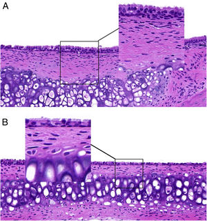 (A) ET from group A presents with ciliated epithelial cell swelling, disordered and shedding cilia, thickened mucosa, and enlarged and expanded capillaries. (B) ET mucosal epithelium from group B revealed slightly swollen ciliated epithelium, with normal and neatly arranged cilia structure.
