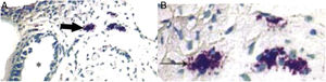 (A) Infiltration of mast cells in the tissue around the ET in group A. The black arrow indicates mast cells. The asterisk (*) corresponds to ET lumen (toluidine blue staining ×400). (B) Degranulation of active mast cells in the tissue around the ET in group A. Black arrow points to activated mast cells (toluidine blue stain ×1000).
