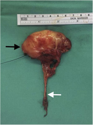 The tumor had engulfed the whole proximal end of the hypoglossal nerve (white arrow). Black arrow shows the cranial end of the tumor.