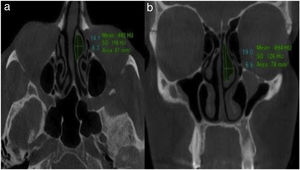 Cone-beam computed tomography images demonstrating (a) anterior-posterior and medio-lateral dimensions as well as overall area in axial plane and (b) height and medio-lateral dimensions in coronal plane.