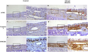 Expression of AIM2, caspase-1, and HMGB1 in the nasal mucosa of mice. AIM2 and caspase-1 were rarely expressed in the nasal mucosa from the control group (A, C). However, after OVA stimulation, the expression of both proteins was up regulated in the epithelium, lamina propria, and infiltrated inflammatory cells (B, D). HMGB1 was abundantly expressed in the epithelium and lamina propria, and mainly located in the nucleus in mucosa from control mice (E). The expression of HMGB1 significantly increased in the nasal mucosa of AR mice and the translocation of HMGB1 from the nucleus to the cytoplasm was observed (F, red arrows).