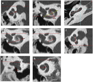 Inner ear CT scan measurements. (a) Height of cochlea on an axial view; (b) Measurements of length A on a reconstruction through modiolus. B measurement corresponds to width of cochlea; (c) Identification of points in basal turn of cochlea via the application “vessel analysis” to measure length of unrolled cochlea; (d) External diameter of basal turn of cochlea on a frontal view; (e) Internal diameter of basal turn of cochlea on a frontal view; (f) Internal diameter of basal turn of cochlea on a sagittal view; (g) RW diameter on a reconstruction from Saylisoy et al.16; (h) Diameter of apical turn of cochlea.