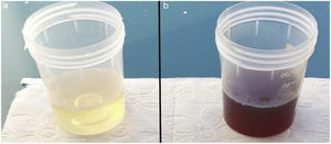The normal colored urine of the patient turned in to black after alkalinization with KOH.