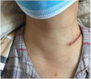The appearance of the incision 3-days after the operation is demonstrated.