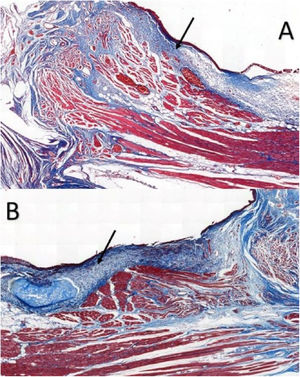 Masson trichrome-stained sections in rabbits at a magnification of 5×: (A) control VF; (B) VF with fibrin glue. Arrows point to the subepithelial region of the VFs. Note higher concentration of collagen in part B, in blue.