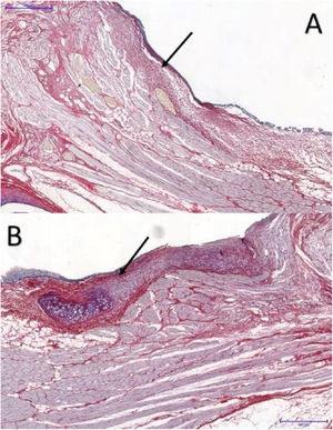 Picrosirius red-stained tissue sections at a magnification of 5×: (A) control VF; (B) VF with FG. Arrows point to the subepithelial region of the VFs. Note higher concentration of collagen in part B, in red.