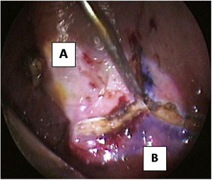 The propeller incision. (A) hard palate; (B) soft palate.