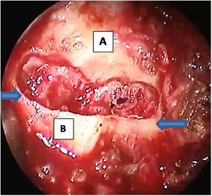 Drilled 1 cm of the posterior hard palate leaving 2-mm of the bone edge and exposing the mucosa without opening it. The arrows refer to the site of the vertical osteotomy to separate the hard and soft palate to enable advancement of the palate, postnasal spine, attached soft palate. (A) hard palate; (B) posterior nasal spine and distal 1-mm of the hard palate.