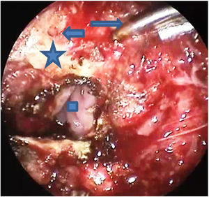 Drill holes in post border of hard palate with the short arrow referring to the hole made on the right side of the posterior hard palate and the long arrow referring to the drill. The square refers to the nasal cavity seen after incision of the mucosa. The star points at the good segment of bone measuring about 4-mm between the drill hole and the edge.