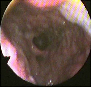 A postoperative nasopharyngoscopy showing wide retropalatal space and well-tensioned lateral pharyngeal walls. The arrow of the camera refers to the soft palate and the froth is on the posterior pharyngeal wall. The arrow refers to the tongue base, the star refers to the posterior pharyngeal wall.