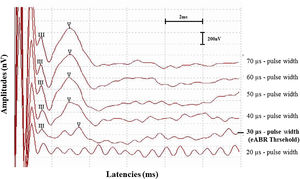Example of eABR detection threshold recorded from subject 6 during the cochlear implant surgery. eABR threshold was defined as the lowest pulse width at which wave V could be detected (30 µs).