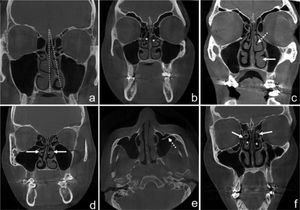CBCT images of sinonasal anatomical variations. Septal deviation angle (a); bilateral CB (asterisk) (b); middle concha hypertrophy (MCH) (dashed arrow), inferior concha hypertrophy (ICH) (white arrow) (c); bilateral paradoxical middle concha (PMC) (white arrows) (d); presence of septa in the maxillary sinus (dashed arrow) (e); bilateral uncinate process pneumatization (UPP) (white arrows) and CB (asterisk) (f).