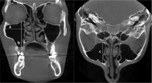 The coronal and axial CBCT images revealing the measurement of the MSW, MSH, and MSL. MSW; the longest distance from the most medial wall of the sinus to the most lateral wall of the sinus (a), MSH; the longest distance between the sinus floor and the sinus roof (b), MSL; the longest distance between the anterior wall and the posterior wall of the sinus (c).