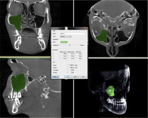 3D volume reconstruction of the maxillary sinus.
