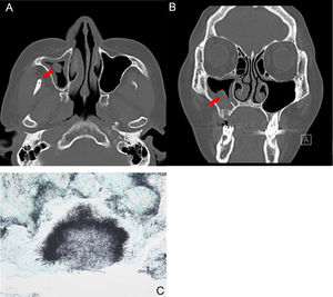 A 53-year-old female patient with actinomycosis of the right maxillary sinus. Axial (A) and coronal, (B) CT scans show partial opacity and fungal ball-like material (red arrow) in the right maxillary sinus. (C) Histopathologic findings show characteristic sulfur granules with chronic inflammation (methenamine silver stain, ×100).
