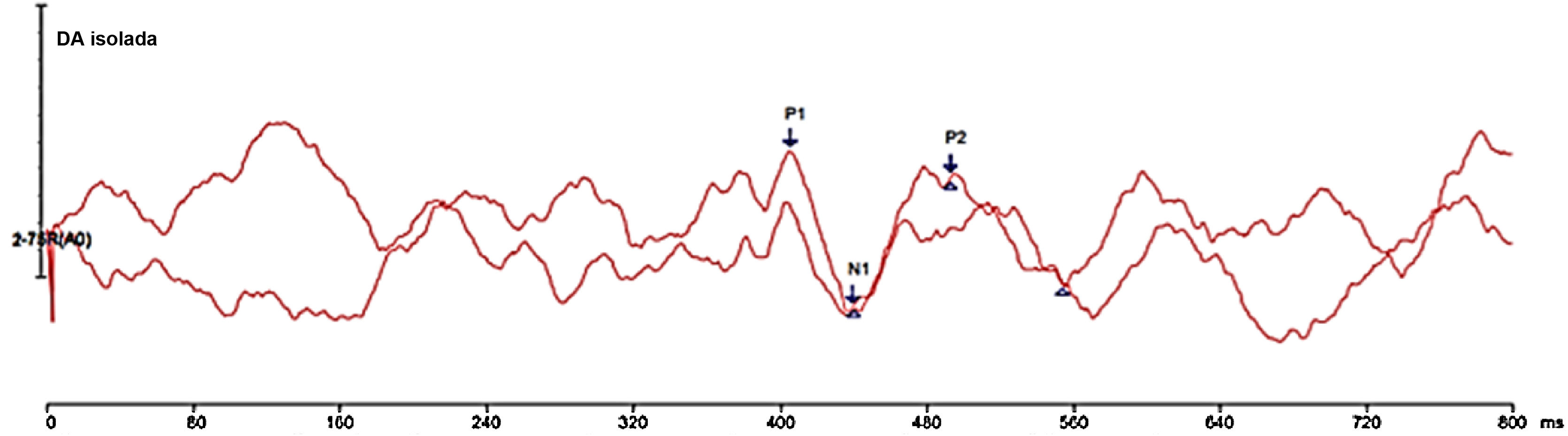The effect of noise on the amplitude and morphology of cortical ...