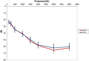 Hearing loss configuration for both ears (mean and standard error). dB, Decibels.