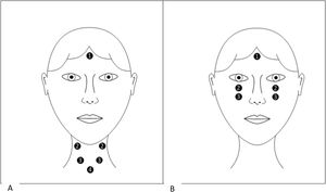 (A) Positioning of electrodes for cVEMP (1- Ground, 2- Active, 3- Electromyography, 4- Reference). (B) Positioning of electrodes for oVEMP (1- Ground, 2- Active, 3- Reference).
