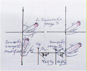 Physicist’s and artist’s impression describing: 1) Right side Semont’s maneuver stage II results in to impingment of FFP at bend between anterior and posterior arm of HSC due to obtuse angulation at ampulla resulting in to effective vector (Ve- with acute angulation to horizontal plane) which fails to propel the debris to posterior arm, as opposed to 2) Left side diagram with stage II of Semont’s maneuver modified resulting in to effective vector (Ve) near to Gravity force (Vg) with less acute angulation to the horizontal plane enabling better clearing of the debris in HSC- Cupulolithiasis.