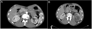 (A) Abdominal CT scan in at the time of diagnosis, (B) Abdominal CT scan axial view of left renal mass. A solid expansive lesion of the medial pole of the left kidney, with the presence of bilobed hypodense area of cystic appearance approximately 40 × 24 mm in the renal parenchyma.