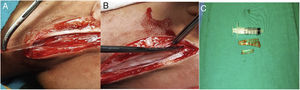 (A) Intraoperative foreign body removal; (B) Intraoperative foreign body is released from surrounding tissue; (C) Foreign bodies removed from the neck (two glass pieces, 7 and 3cm).