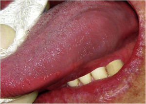 Clinical lesion presented as a swelling of lateral border of the tongue.
