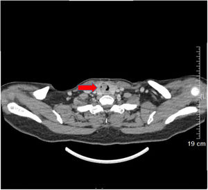 Trachea spiral CT shown a tracheal mass resulting in a 90% obstruction of trachea lumen.