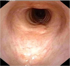 Appearance of trachea 3 month after second surgery on electronic laryngoscope.