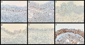 Rare brown MCM staining in basal nuclei in normal nasopharyngeal epithelium: (a) MCM2; (b) MCM3; (c) MCM5; (d) MCM6; (e) MCM7; (f) MCM6 strong staining in epithelium with random atypical dysplasic changes in one of the samples. Magnification ×400.