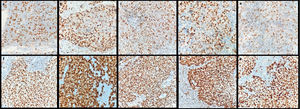 Brown positivity rates in nuclei of tumor cells: (a) low-MCM2; (b) low-MCM3; (c) low-MCM5; (d) low-MCM6; (e) low-MCM7; (f) high-MCM2; (g) high-MCM3; (h) high-MCM5; (i) high-MCM6; (k) high-MCM7 in MCM immunohistochemical staining. Magnification ×400.