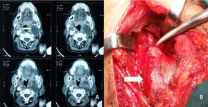 (A) Image showing the axial section of Contrast CT Scan of Vagal Schwannoma. The white arrow pointing towards the right side shows the well-encapsulated schwannoma with cystic change and central enhancing solid component. Vagal schwannoma separates the carotid anteromedially and internal jugular vein anterolaterally. (B) An intraoperative picture of vagal schwannoma is shown by the white arrow pointing towards the right side.