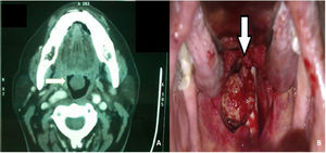 (A) Image showing the axial section of contrast CT scan of Base of Tongue Schwannoma. The white arrow pointing towards the right side shows the schwannoma with stalk attached to the base of the tongue. (B) An intraoperative picture of schwannoma arising from the base of the tongue is shown by the white arrow pointing downwards.