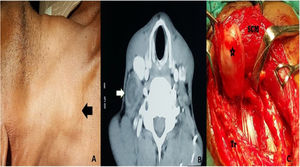 (A) Image showing right-sided brachial plexus schwannoma presenting as swelling in the neck. The lesion is shown by a black arrow pointing towards the left side. (B) Contrast CT scan of brachial plexus schwannoma. A white arrow pointing towards the right side shows the brachial plexus schwannoma, which arises posterolateral to the carotid sheath. (C) Intraoperative picture of brachial plexus schwannoma marked by a black star. Brachial plexus schwannoma is seen deep to sternocleidomastoid. SCM, Sternocleidomastoid; Tr, Trapezius.